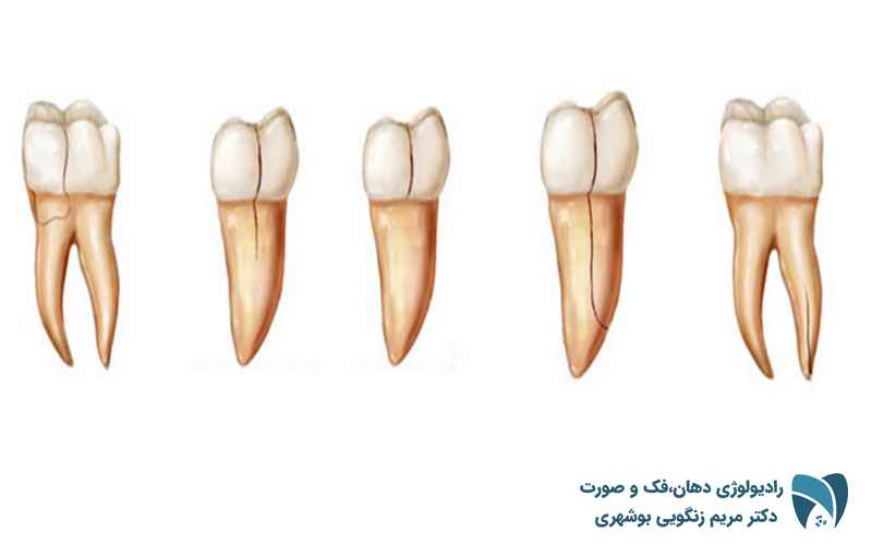 شکستگی ریشه دندان ; drbooshehri.com