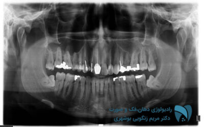 عکسبرداری دندان ; drbooshehri.com