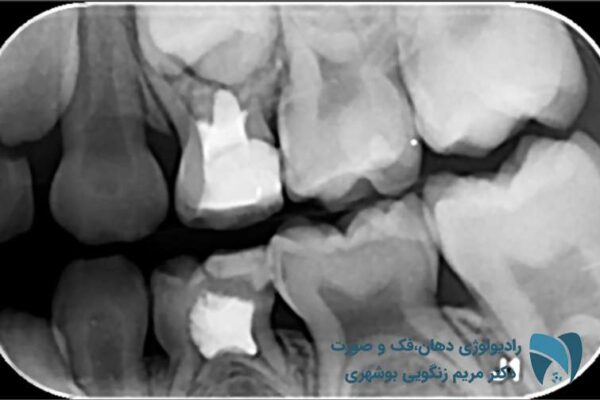 رادیولوژی دندان کودکان | دارای اتاق مخصوص کودک; بایت وینگ; drbooshehri.com