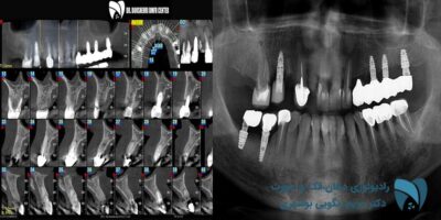 تفاوت opg و Cbct ; drbooshehri.com