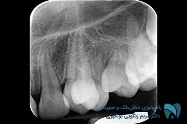 رادیولوژی دندان کودکان | دارای اتاق مخصوص کودک; رادیوگرافی های پری اپیکال ; drbooshehri.com