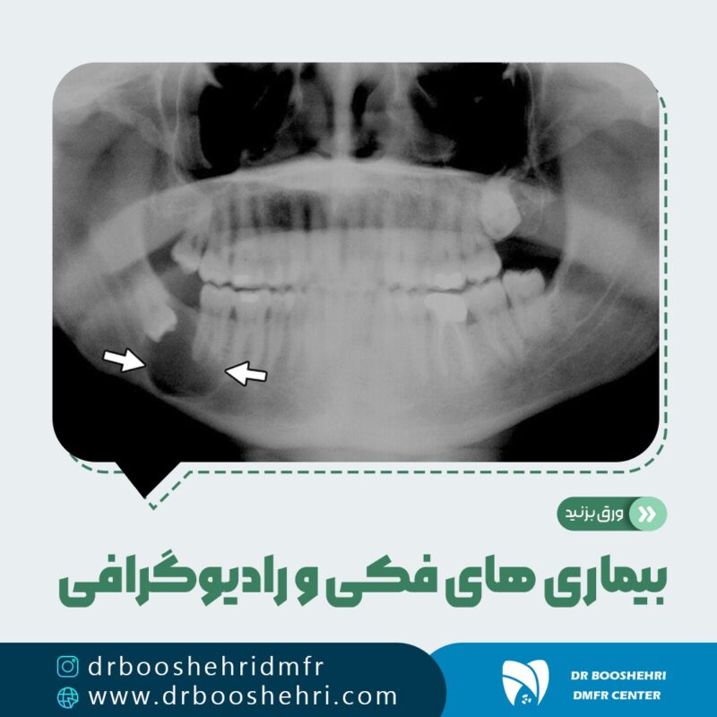 رادیولوژی دهان: تشخیص بیماری‌های دهان با استفاده از پرتونگاری