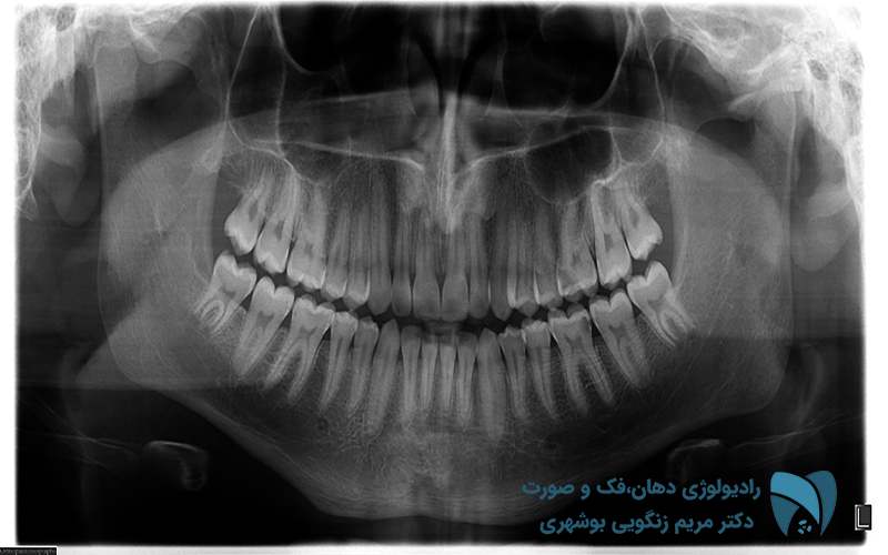 عکس OPG دندان چیست؟; drbooshehri.com