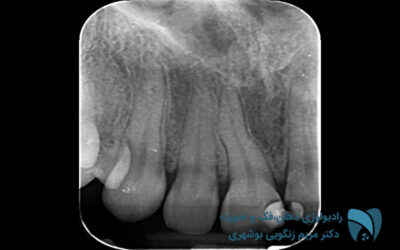 رادیوگرافی دندان; drbooshehri.com