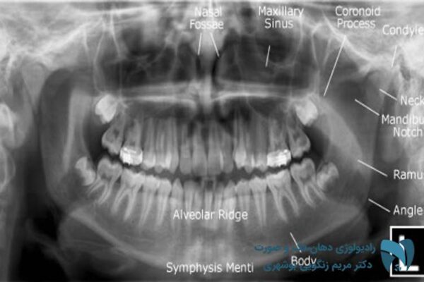 عکس OPG دندان 2; drbooshehri.com