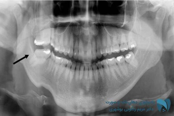 مرکز عکس opg دندان; drbooshehri.com