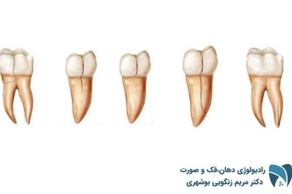 شکستگی ریشه دندان1; drbooshehri.com
