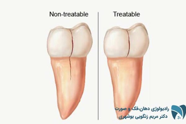 شکستگی ریشه دندان2; drbooshehri.com