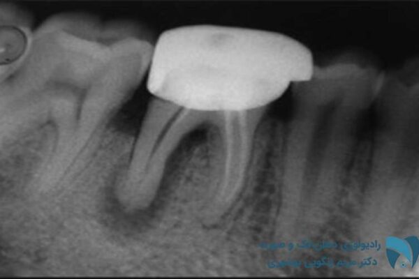 شکستگی ریشه دندان4; drbooshehri.com