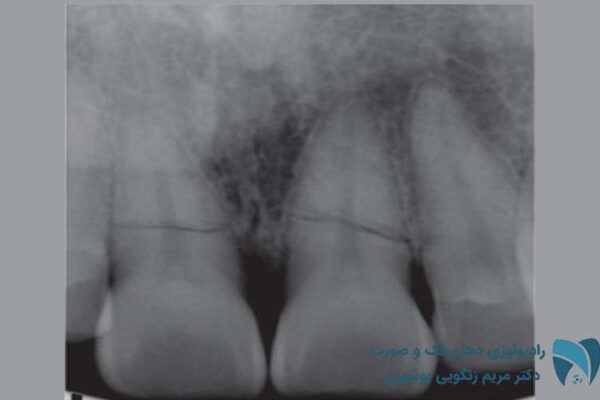 شکستگی ریشه دندان6; drbooshehri.com