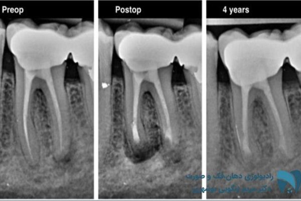 شکستگی ریشه دندان7; drbooshehri.com