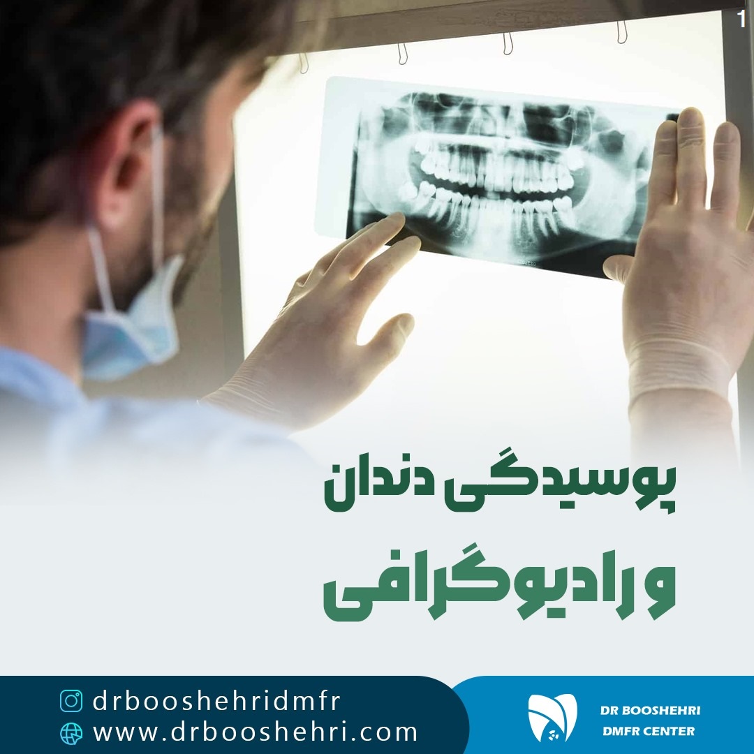 پوسیدگی دندان و رادیوگرافی