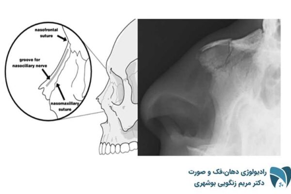شکستگی با جابجایی در استخوان بینی ; drbooshehri.com