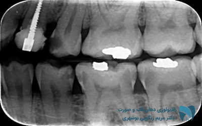 بایت وینگ چیست ; drbooshehri.com
