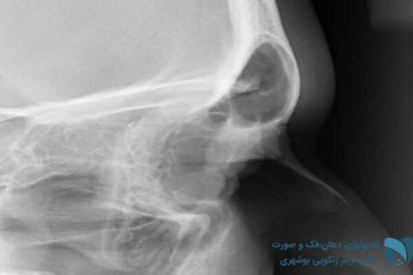بررسی استخوان بینی (تصویر دوم) ; drbooshehri.com