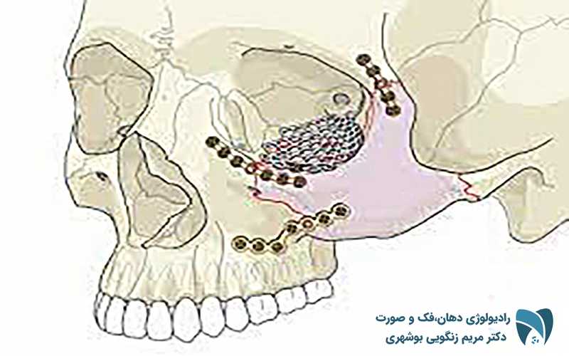 انواع شکستگی استخوان صورت ; drbooshehri.com