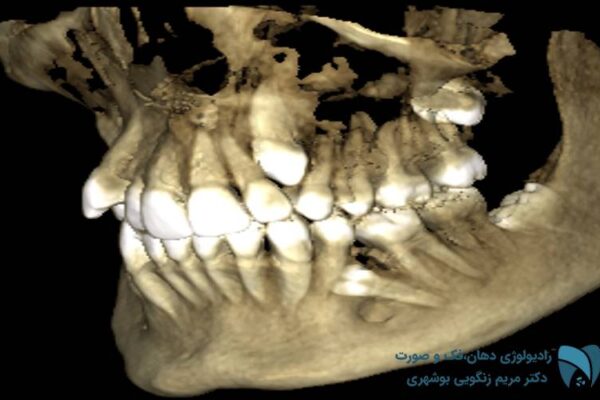 دندان های نهفته، نمای راست ; drbooshehri.com
