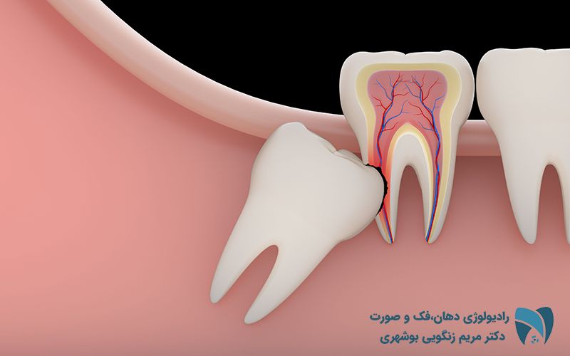 دندان های نهفته ; drbooshehri.com