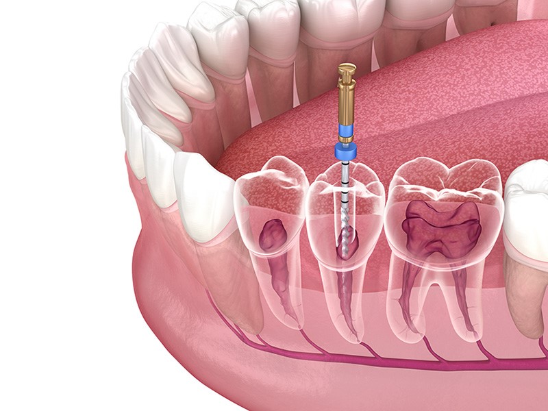 اهمیت رادیوگرافی در عصب کشی و ترمیم ریشه دندان