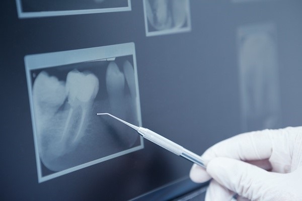 دوزاشعه در رادیوگرافی دهان و دندان