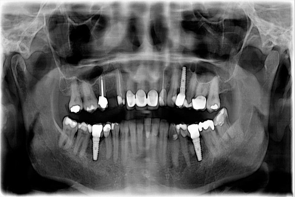 ایمپلنت دندان | آشنایی با رادیوگرافی های ایمپلنت