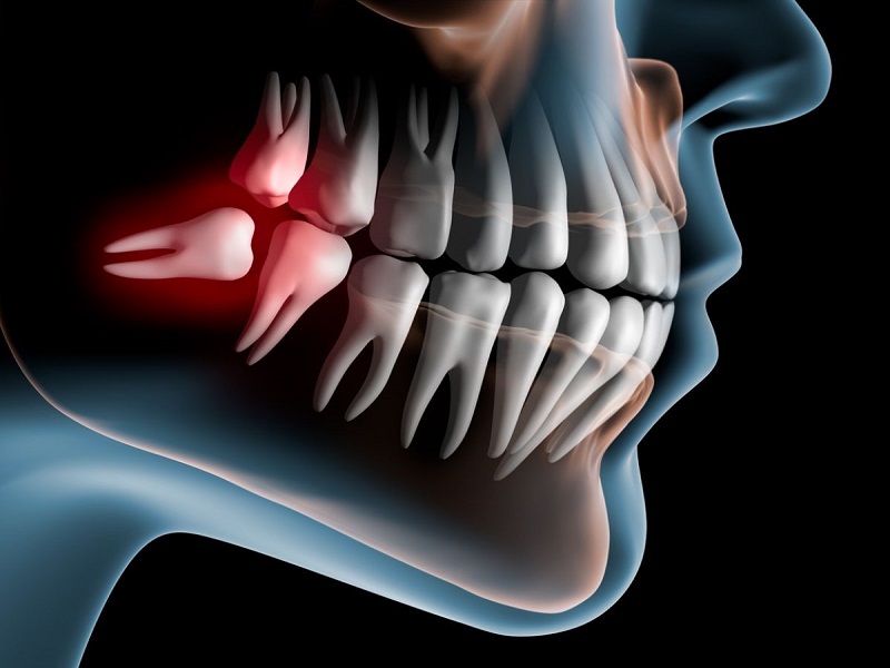 رادیوگرافی دندان|همه چیز در مورد دندان عقل