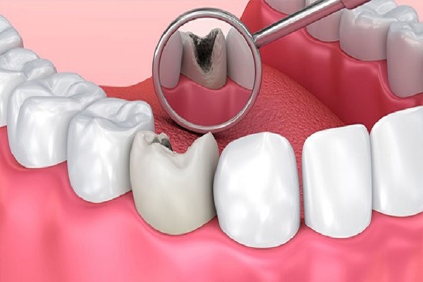 پالپوتومی یا عصب کشی دندان شیری
