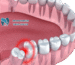 In this article, we explore the causes of wisdom teeth decay, treatment and prevention methods for infection, as well as post-surgery care for wisdo