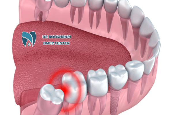 In this article, we explore the causes of wisdom teeth decay, treatment and prevention methods for infection, as well as post-surgery care for wisdo