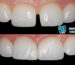 Composite bonding is an advanced restorative technique for teeth with various advantages and disadvantages. This article addresses all your questions about it.