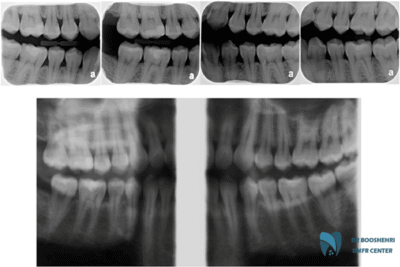 Use bitewing radiography for the Diagnosis of gum diseases and take advantage of its 3 key benefits for the Evaluation of gum diseases.