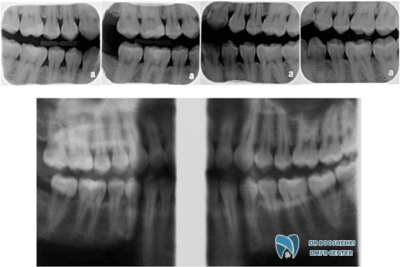 Evaluation of jawbone health through jawbone radiography is a vital process in maintaining oral and dental health, enabling accurate diagnosis and prevention of oral and dental issues.