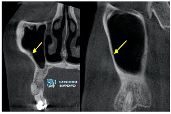 Use CBCT and MCT for Sinusitis Diagnosis and learn about the advantages and disadvantages of each method. Comprehensive and useful information awaits you here.