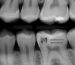 Bitewing radiography is a key tool for diagnosing tooth decay. In this article, you will learn about its applications. Additionally, we have answered important questions regarding this topic.
