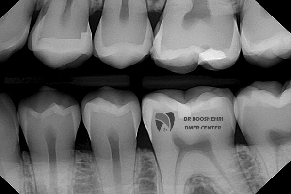 Bitewing radiography is a key tool for diagnosing tooth decay. In this article, you will learn about its applications. Additionally, we have answered important questions regarding this topic.