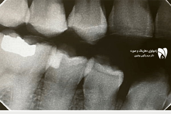 ارزیابی وضعیت دندان‌های ترمیم شده با رادیوگرافی بایت وینگ، اهمیت و مزایای ارزیابی وضعیت دندان های ترمیم شده را کشف کنید و سلامت دندان‌های خود را حفظ کنید.