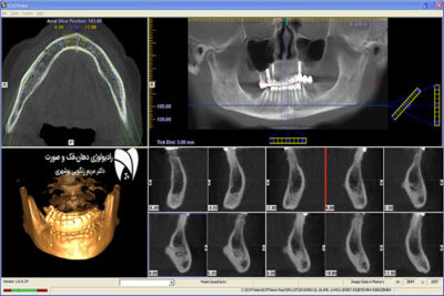 مقایسه CBCT و MCT در دندانپزشکی کشف مزایا و معایب هر روش تصویربرداری و انتخاب بهترین گزینه برای درمان دندان.