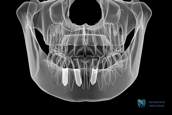 Dental implant radiology is essential! Learn the importance of dental implant imaging and the benefits of advanced radiology techniques.
