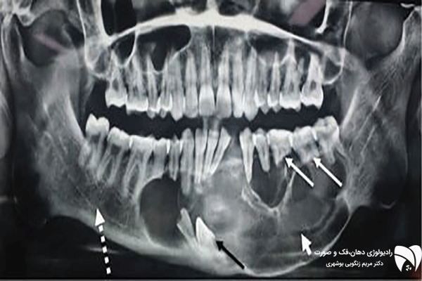تشخیص کیست فک با رادیولوژی پیشرفته. مقایسه کیست و تومور فکی، مزایای تصویربرداری کیست دهان و رادیولوژی تومور فکی در تشخیص دقیق.