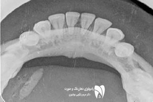 تشخیص بیماری‌های غدد بزاقی با رادیولوژی دهان و فک و تصویربرداری غدد بزاقی آسان‌تر شده است. با ما همراه شوید تا بهترین روش‌ها را بشناسید.