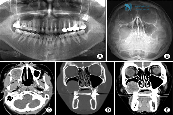 Waters sinus imaging is a precise method to analyze the connection between the sinuses and teeth. Discover sinus and dental issues effectively.