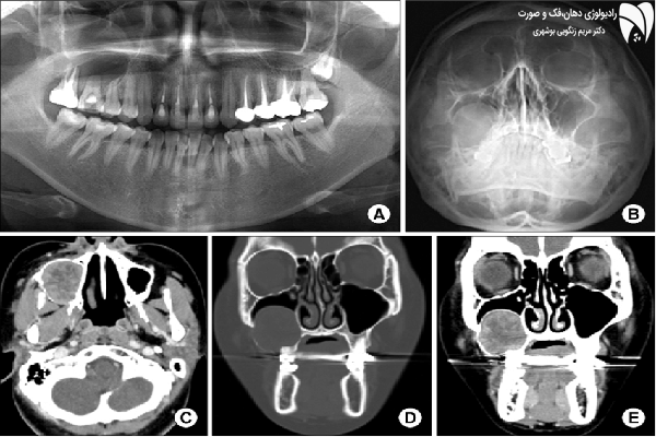 تصویر واترز سینوس‌ها روشی دقیق برای بررسی ارتباط بین سینوس‌ها و دندان‌ها است. با این رادیوگرافی، مشکلات سینوسی و دندانی را بهتر بشناسید.