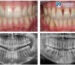 Discover how gum diseases are diagnosed using radiographic imaging. Learn about X-ray risks, benefits, and accurate diagnosis methods.