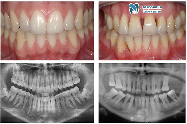 Discover how gum diseases are diagnosed using radiographic imaging. Learn about X-ray risks, benefits, and accurate diagnosis methods.