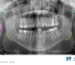 Specialized jaw radiography for patients with limited mouth opening. Discover advanced techniques and CBCT advantages for accurate diagnosis.