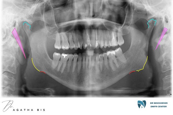 Specialized jaw radiography for patients with limited mouth opening. Discover advanced techniques and CBCT advantages for accurate diagnosis.
