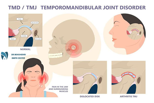 Discover the causes, symptoms, and 5 imaging techniques for TMJ disorders with advanced jaw radiography methods.