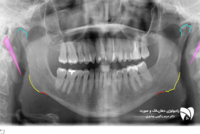 رادیوگرافی فک برای بیماران با محدودیت باز کردن دهان. آشنایی با تکنیکهای پیشرفته و مزایای CBCT برای تشخیص دقیق.