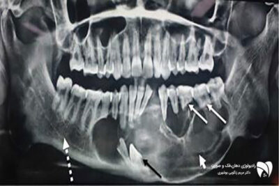 تشخیص ضایعات فکی به صورت دقیق با روش‌های تصویربرداری دهان و تصویربرداری دقیق مفصل فکی، دقت و سرعت را در شناسایی مشکلات فک افزایش می‌دهد.