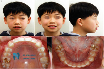 Explore 6 benefits of lateral cephalometry for kids in orthodontics, including its role in growth prediction, treatment planning, and error reduction.